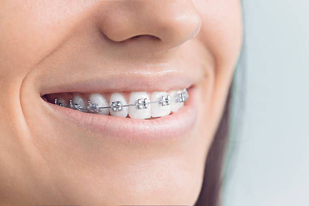Dental Bonding in Gloversville, NY